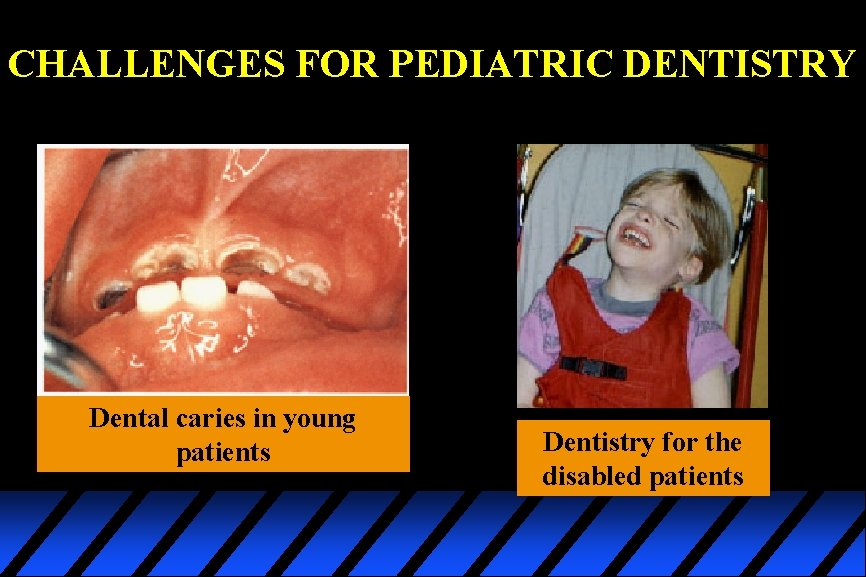 CHALLENGES FOR PEDIATRIC DENTISTRY Dental caries in young patients Dentistry for the disabled patients