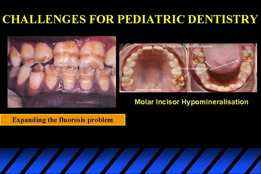 CHALLENGES FOR PEDIATRIC DENTISTRY Molar Incisor Hypomineralisation Expanding the fluorosis problem 