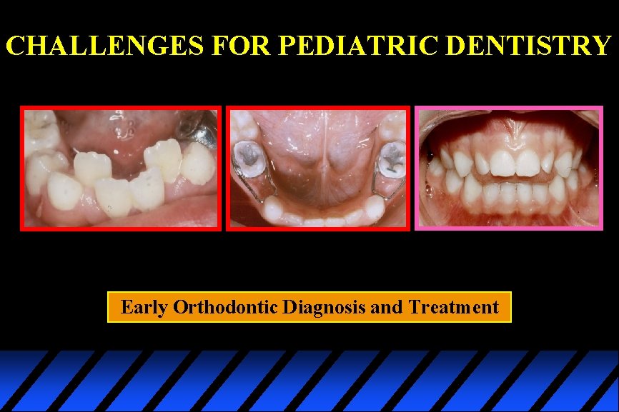 CHALLENGES FOR PEDIATRIC DENTISTRY Early Orthodontic Diagnosis and Treatment 