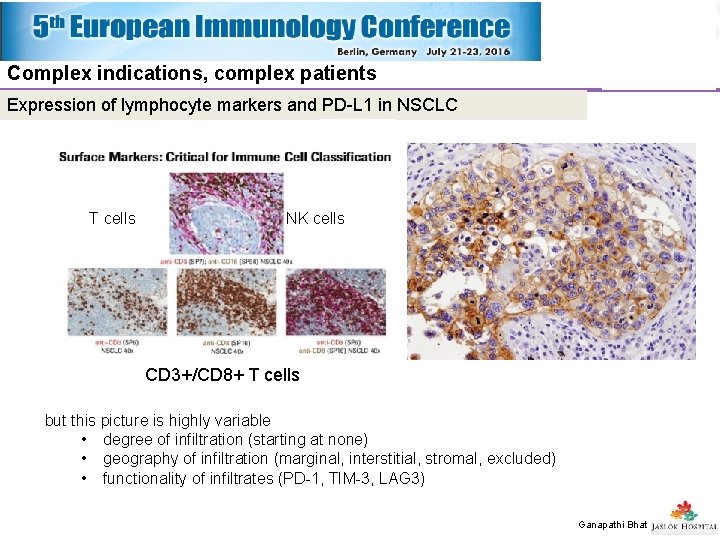 Complex indications, complex patients Expression of lymphocyte markers and PD-L 1 in NSCLC T Complex indications, complex patients Expression of lymphocyte markers and PD-L 1 in NSCLC T