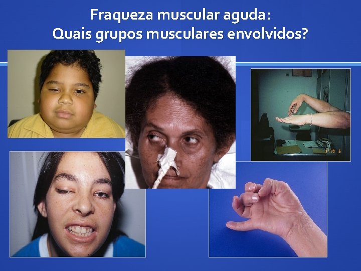 Fraqueza muscular aguda: Quais grupos musculares envolvidos? 