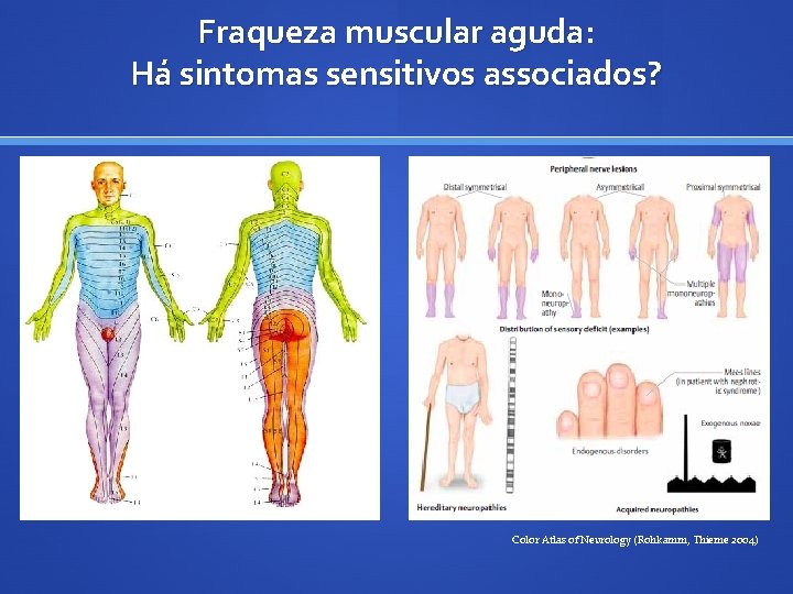 Fraqueza muscular aguda: Há sintomas sensitivos associados? Color Atlas of Neurology (Rohkamm, Thieme 2004)