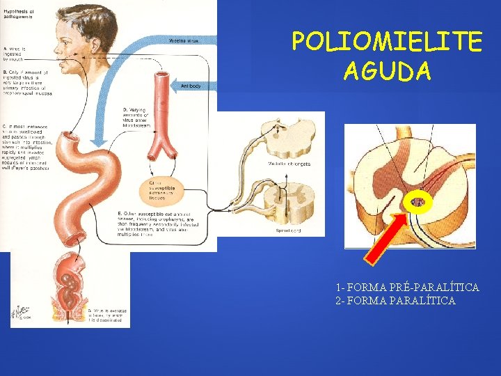 POLIOMIELITE AGUDA 1 - FORMA PRÉ-PARALÍTICA 2 - FORMA PARALÍTICA 