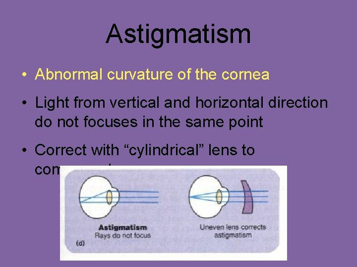Astigmatism • Abnormal curvature of the cornea • Light from vertical and horizontal direction