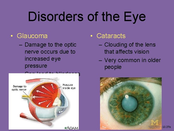Disorders of the Eye • Glaucoma – Damage to the optic nerve occurs due