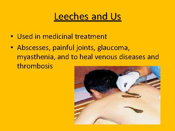 Leeches and Us • Used in medicinal treatment • Abscesses, painful joints, glaucoma, myasthenia,