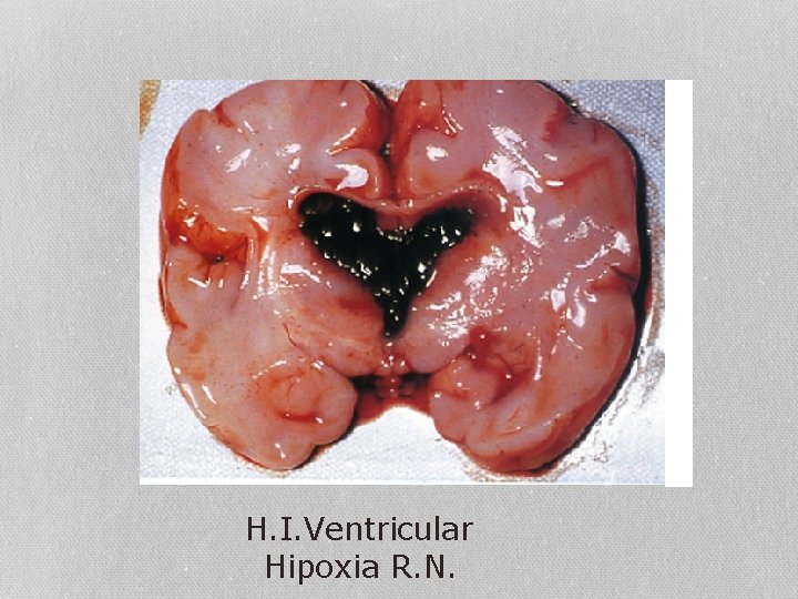 H. I. Ventricular Hipoxia R. N. 