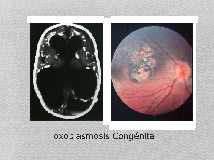 Toxoplasmosis Congénita 