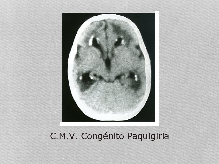 C. M. V. Congénito Paquigiria 