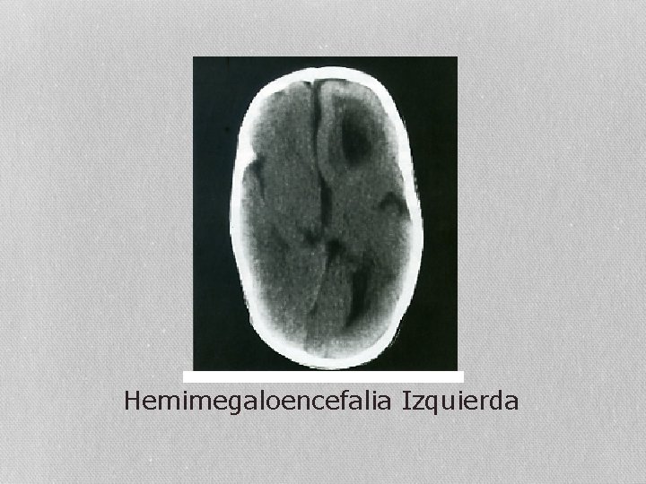 Hemimegaloencefalia Izquierda 