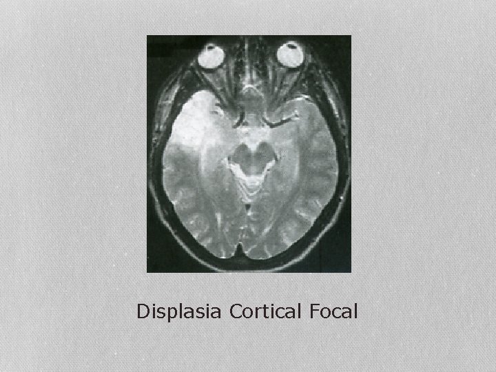 Displasia Cortical Focal 