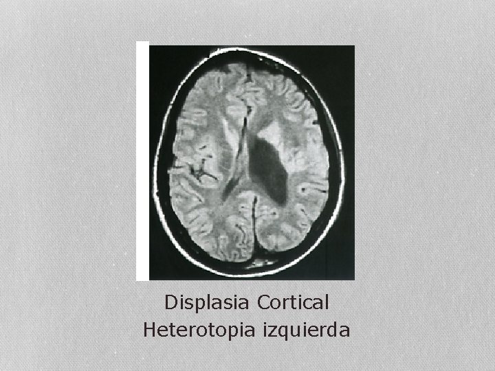 Displasia Cortical Heterotopia izquierda 