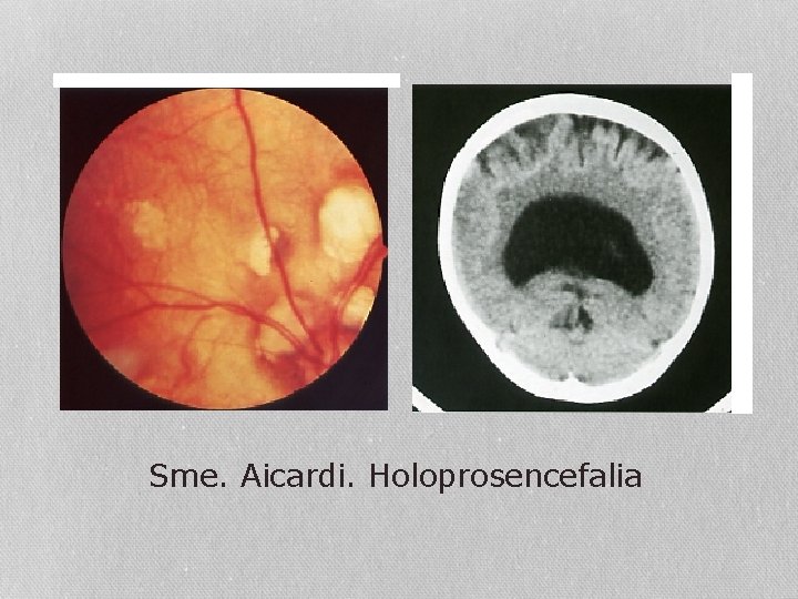 Sme. Aicardi. Holoprosencefalia 