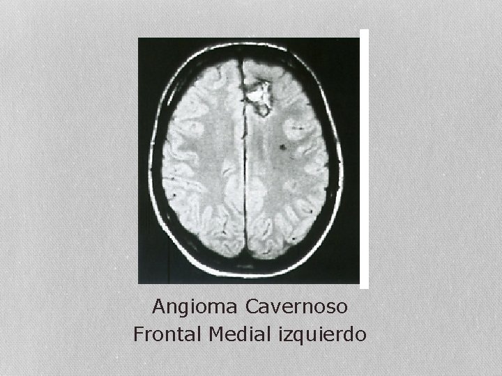 Angioma Cavernoso Frontal Medial izquierdo 