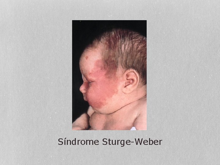 Síndrome Sturge-Weber 