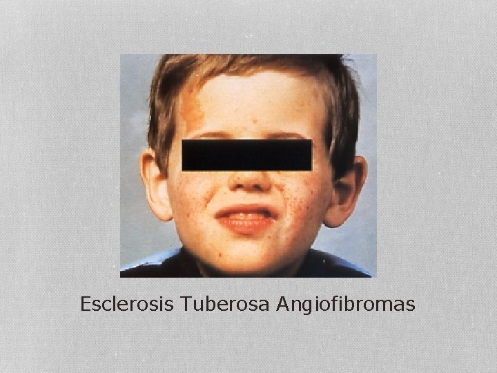 Esclerosis Tuberosa Angiofibromas 