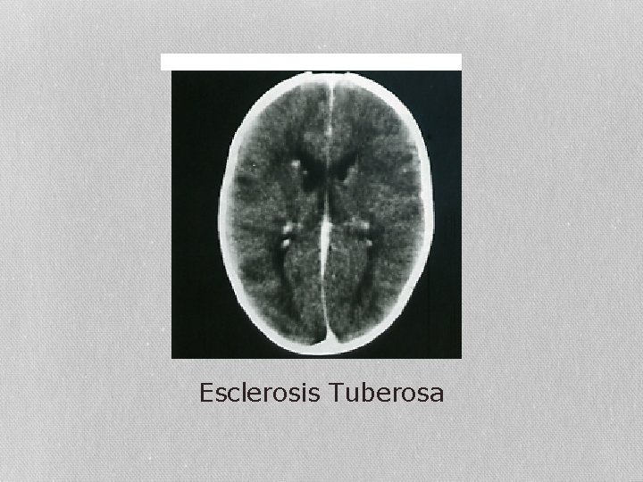 Esclerosis Tuberosa 