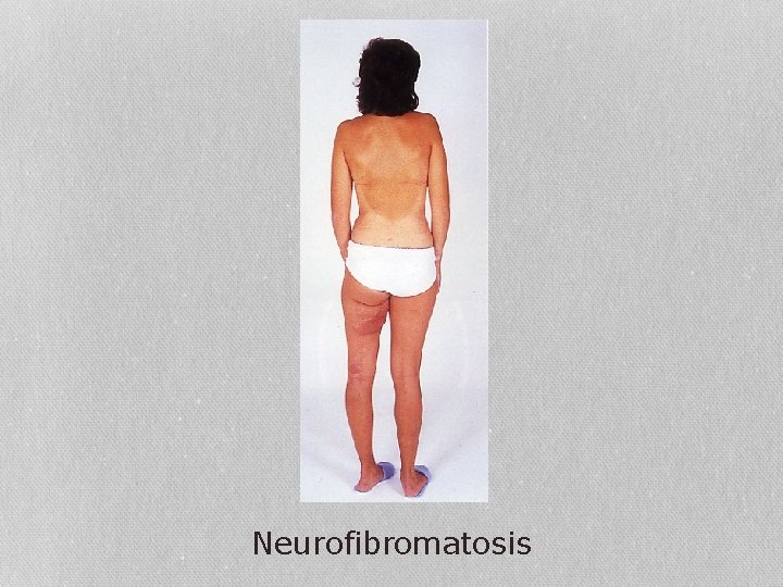 Neurofibromatosis 