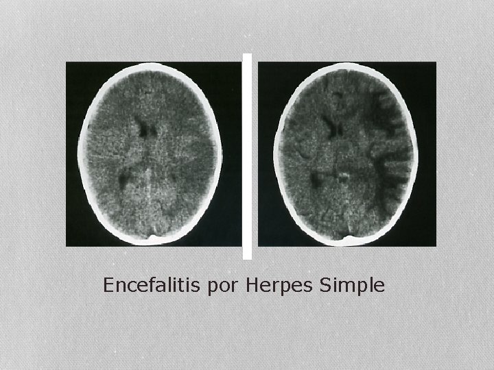 Encefalitis por Herpes Simple 