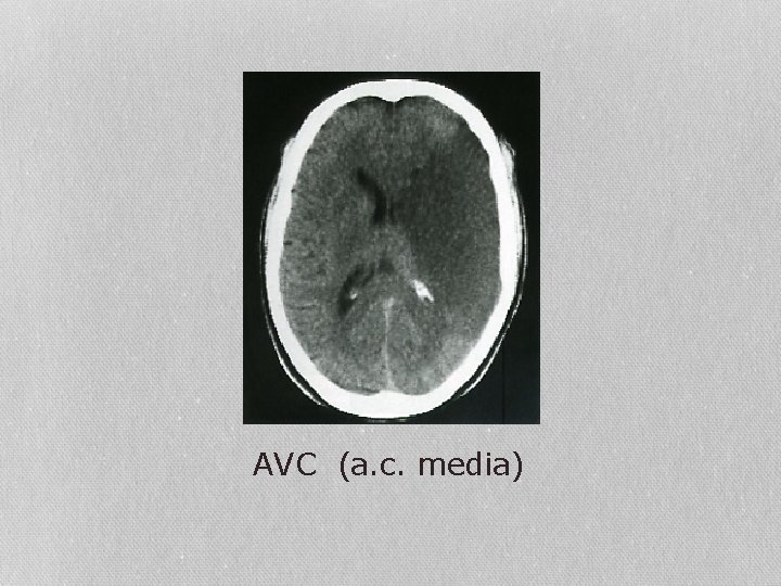AVC (a. c. media) 