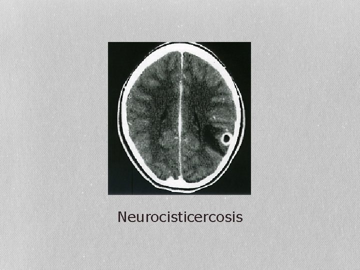Neurocisticercosis 
