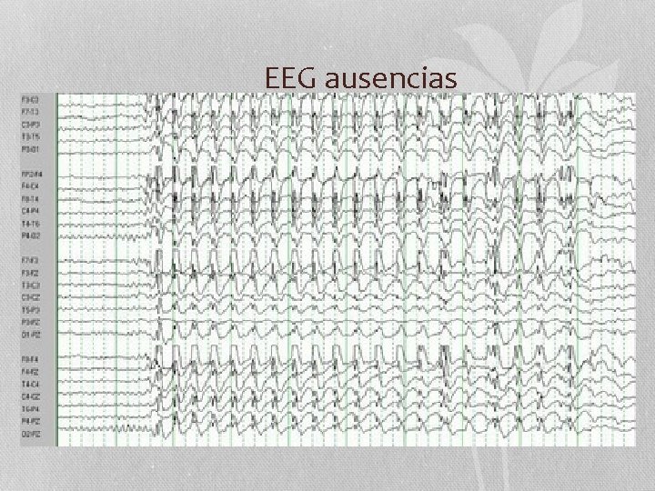 EEG ausencias 