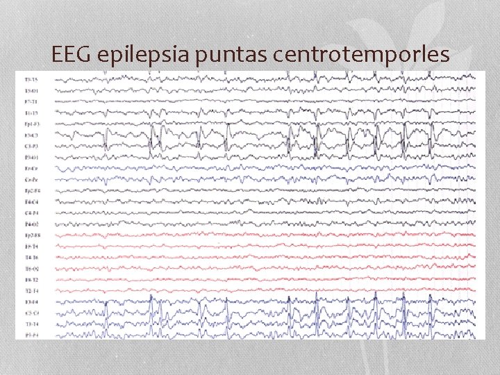 EEG epilepsia puntas centrotemporles 
