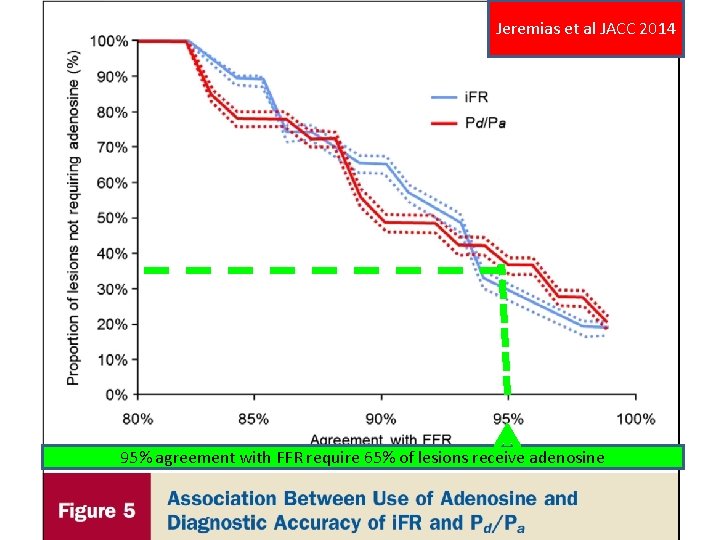 Jeremias et al JACC 2014 95% agreement with FFR require 65% of lesions receive