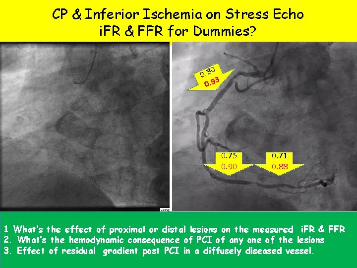 CP & Inferior Ischemia on Stress Echo i. FR & FFR for Dummies? 0