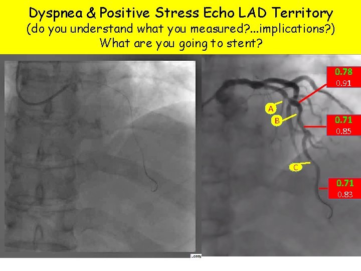 Dyspnea & Positive Stress Echo LAD Territory (do you understand what you measured? .