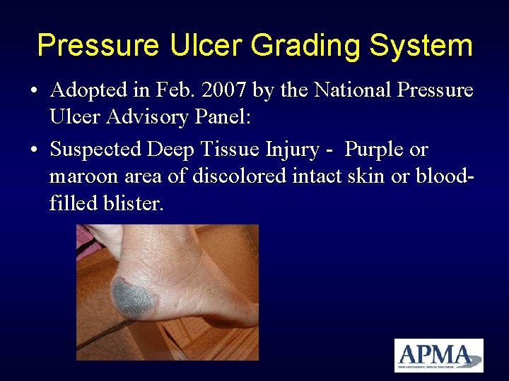 Pressure Ulcer Grading System • Adopted in Feb. 2007 by the National Pressure Ulcer Pressure Ulcer Grading System • Adopted in Feb. 2007 by the National Pressure Ulcer