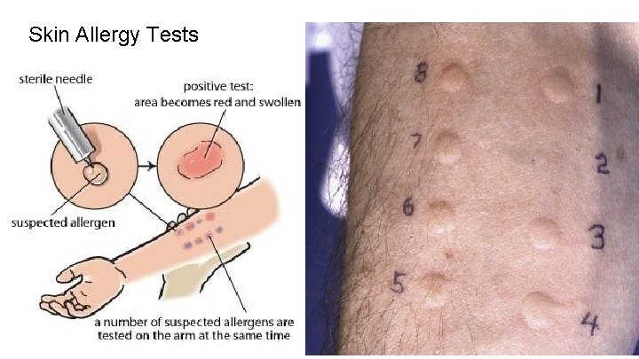 Skin Allergy Tests 