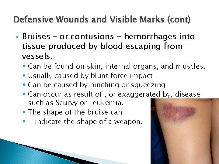 Defensive Wounds and Visible Marks (cont) § Bruises – or contusions - hemorrhages into