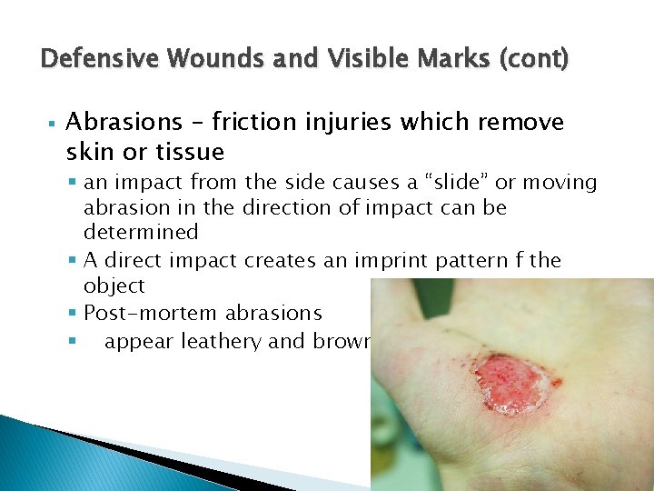 Defensive Wounds and Visible Marks (cont) § Abrasions – friction injuries which remove skin