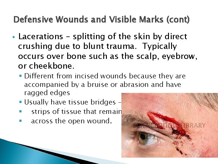 Defensive Wounds and Visible Marks (cont) § Lacerations – splitting of the skin by