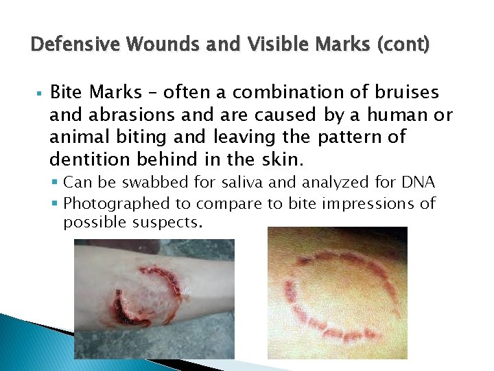 Defensive Wounds and Visible Marks (cont) § Bite Marks – often a combination of