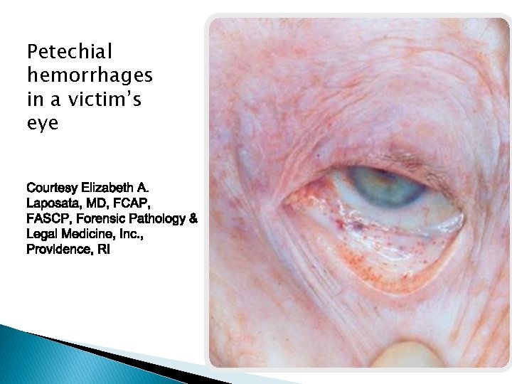 Petechial hemorrhages in a victim’s eye 