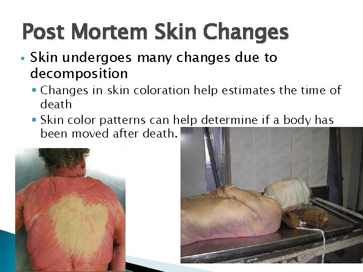 Post Mortem Skin Changes § Skin undergoes many changes due to decomposition § Changes