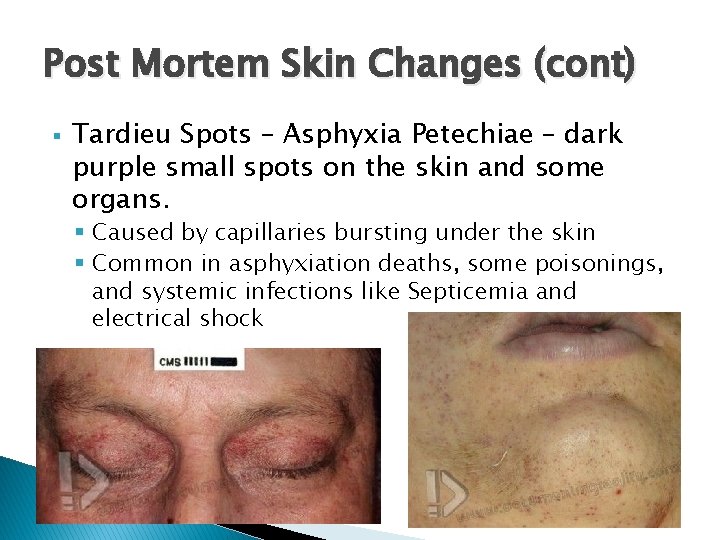 Post Mortem Skin Changes (cont) § Tardieu Spots – Asphyxia Petechiae – dark purple