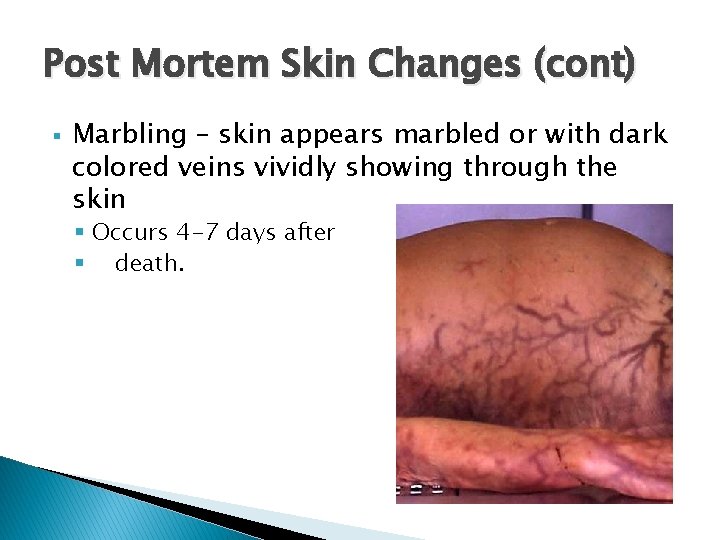 Post Mortem Skin Changes (cont) § Marbling – skin appears marbled or with dark