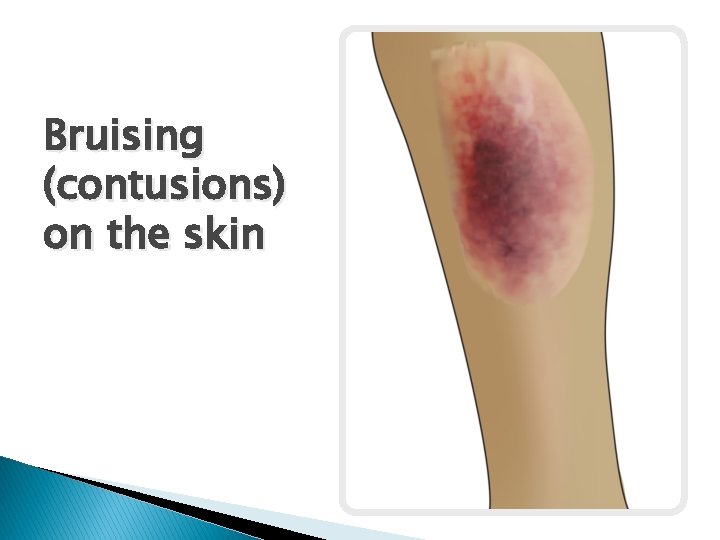 Bruising (contusions) on the skin 