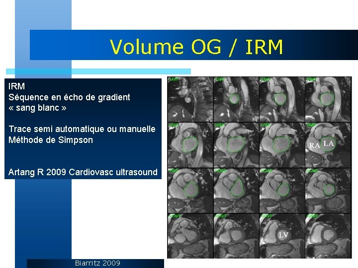 Volume OG / IRM Séquence en écho de gradient « sang blanc » Trace