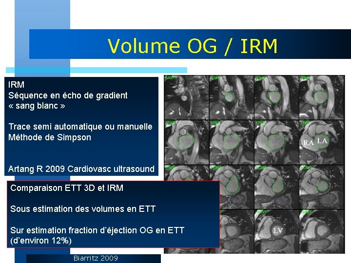 Volume OG / IRM Séquence en écho de gradient « sang blanc » Trace