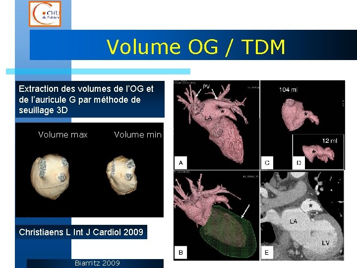 Volume OG / TDM Extraction des volumes de l’OG et de l’auricule G par