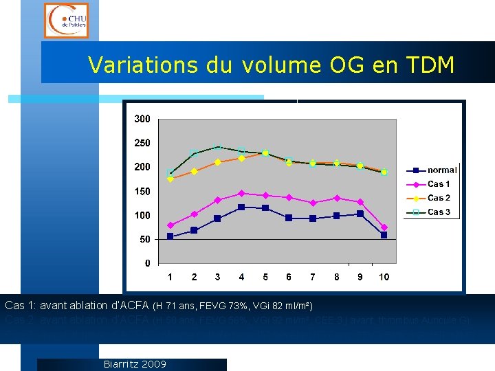 Variations du volume OG en TDM Cas 1: avant ablation d’ACFA (H 71 ans,