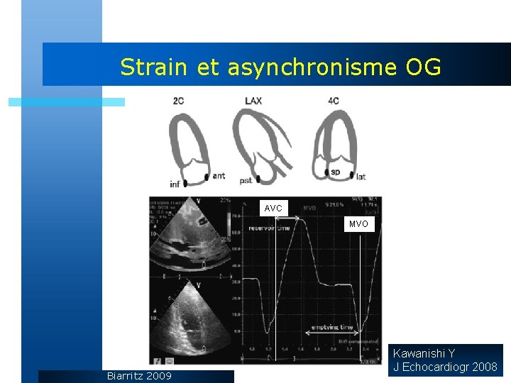 Strain et asynchronisme OG AVC MVO Biarritz 2009 Kawanishi Y J Echocardiogr 2008 