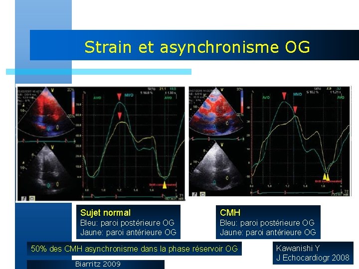 Strain et asynchronisme OG Sujet normal CMH Bleu: paroi postérieure OG Jaune: paroi antérieure