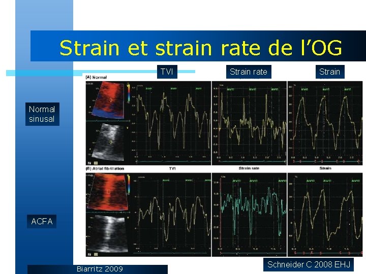 Strain et strain rate de l’OG TVI Strain rate Strain Normal sinusal ACFA Biarritz