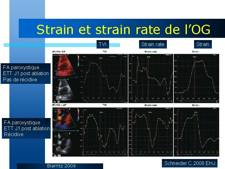 Strain et strain rate de l’OG TVI Strain rate Strain FA paroxystique ETT J