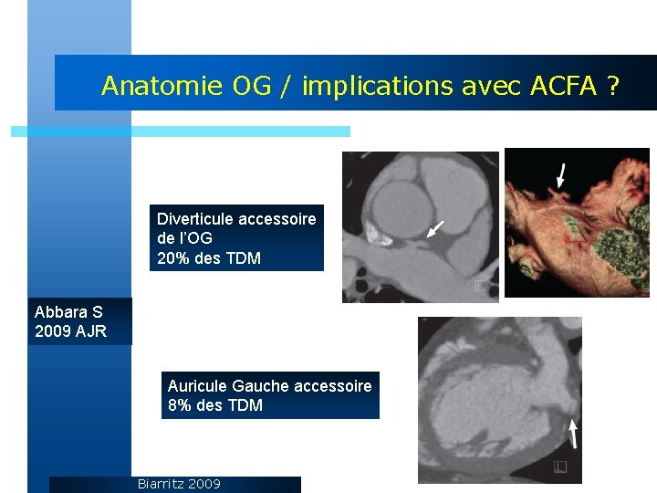 Anatomie OG / implications avec ACFA ? Diverticule accessoire de l’OG 20% des TDM